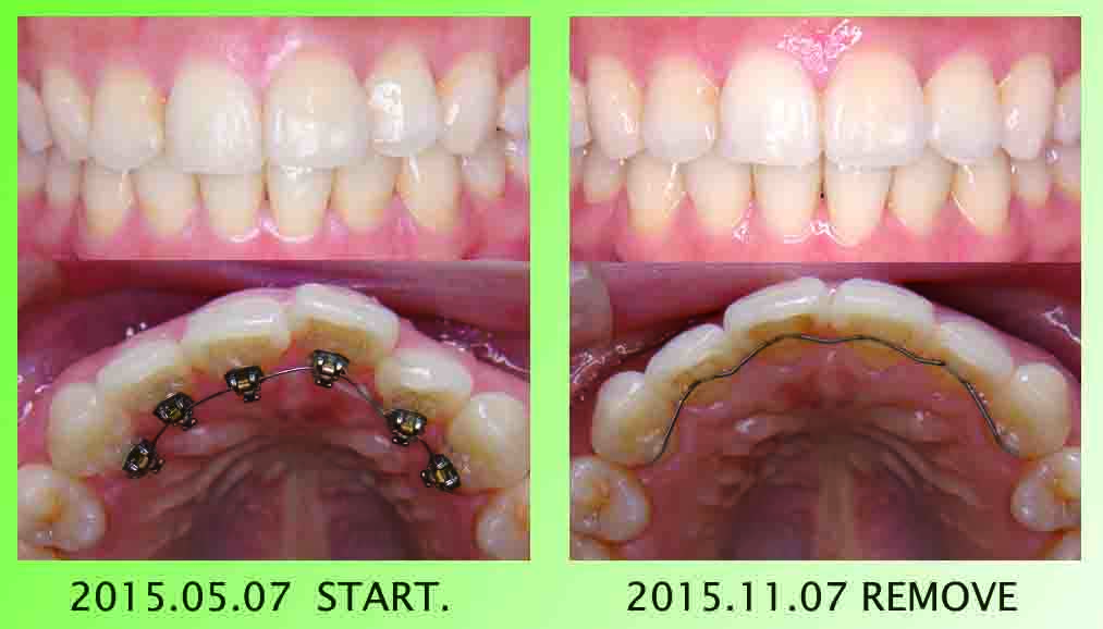 2015.12.16 update 矯正治療終了していましたのお話