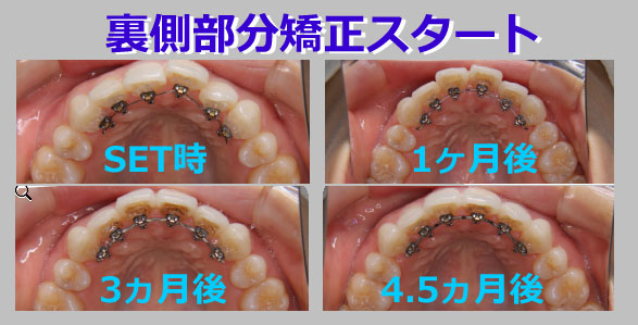 2016.11.19 update 実録・矯正レポート２：後戻り、治します。