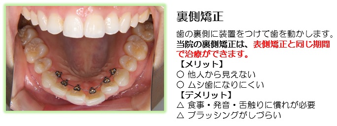 2017.3.8 update 専門用語のお話～舌側矯正～