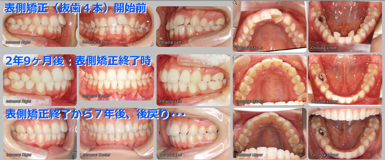 2016.11.14 update 実録・矯正レポート１：表側矯正とその後･･･