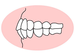 上下顎前突（じょうげがくぜんとつ）
